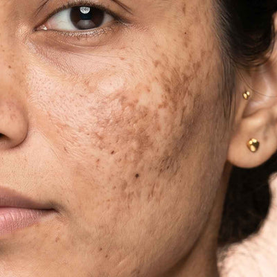 Pigmentation