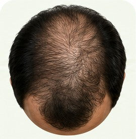 Stage 4